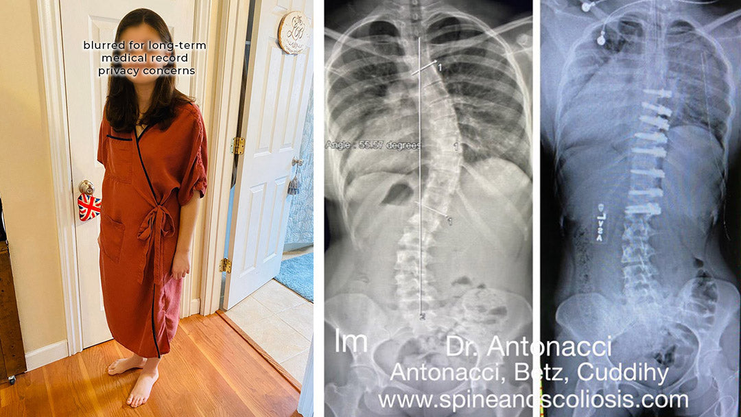 Innovative ASC Scoliosis Surgery and Recovery